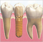 implant_img01.jpg